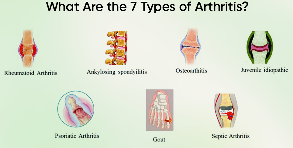 The 7 types of arthritis