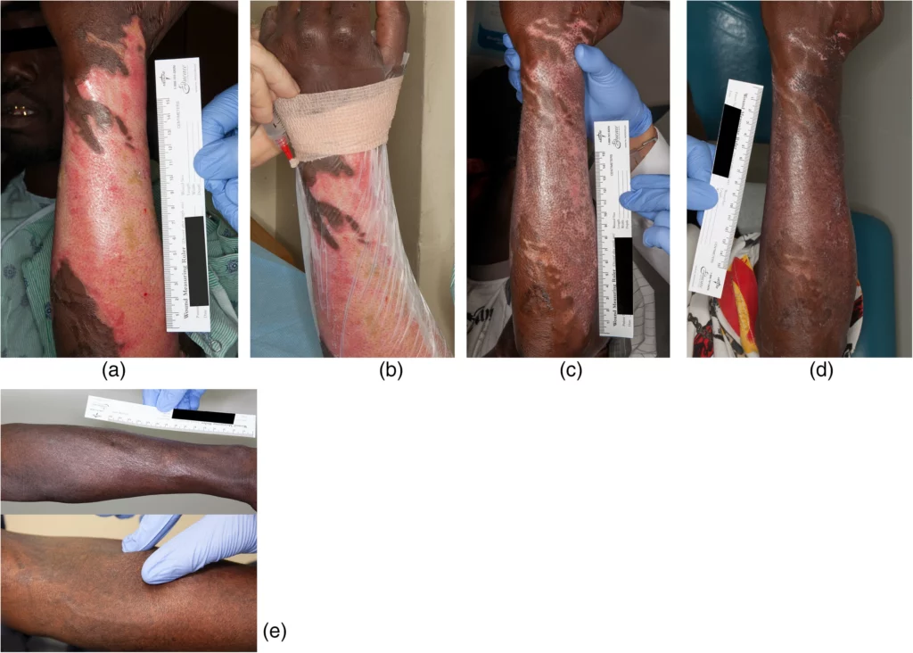a 47-year-old African American man who accidentally submerged his arm in hot oil attempting to catch a falling fry basket. (a) Wound before treatment. (b) Transparent film dressing applied to patient’s arm and BM-MSC were injected between the wound and transparent dressing. (c) Ten days after first treatment. (d) Seven days after second treatment (17 days after first treatment). (e) One year after treatment and showing limited to no fibrosis with pinch test.